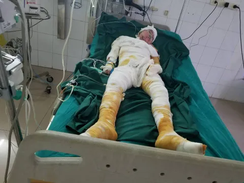 Cô gái trẻ bị bỏng nặng có hoàn cảnh đặc biệt khó khăn