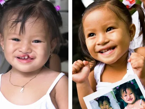 Phẫu thuật trao “nụ cười miễn phí” cho 100 em nhỏ kém may mắn trong tháng 12