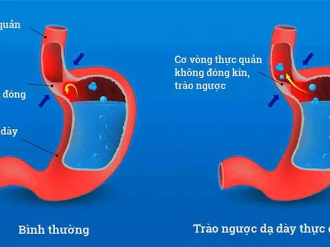 Cách chữa bệnh trào ngược dạ dày hiệu quả từ nghiên cứu của GS người Đức