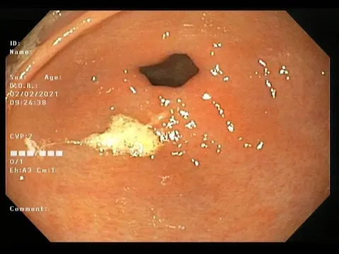 Giật mình về nguyên nhân gây viêm loét dạ dày ở trẻ 9 tuổi