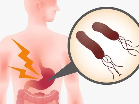 3 nguyên nhân bệnh trào ngược dạ dày phổ biến nhất và cách khắc phục tận gốc