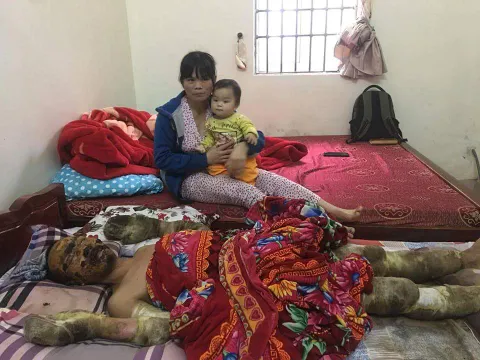 Gia đình rơi vào cảnh khốn khó khi lao động chính bị bỏng nặng