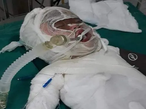 Ngã xuống lò vôi bị bỏng tới 86%, cháu bé đang rất cần sự giúp đỡ