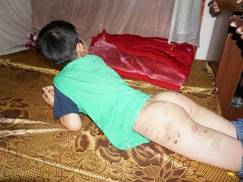 Hà Nội: Thêm một bé trai 9 tuổi bị bố đẻ bạo hành