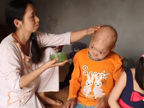 Xót thương 2 bé mắc bệnh da khô vảy cá bị bạn gọi là ‘con ma”