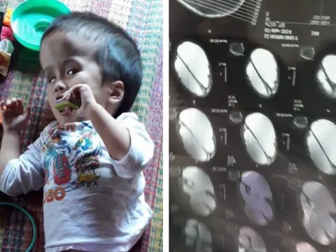 Bé gái bị não úng thủy ở Quảng Nam đang rất cần kinh phí để chạy chữa