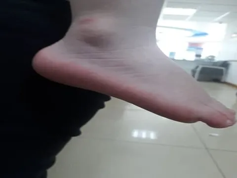 Dấu hiệu cảnh báo trẻ mắc bệnh Kawasaki