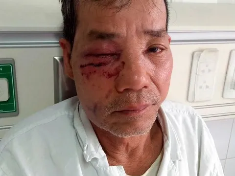 Lâm tặc phục kích ném đá cán bộ kiểm lâm trọng thương