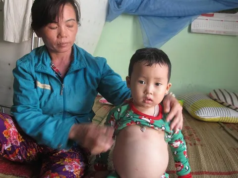 Mắc bệnh gan nặng, bé trai 4 tuổi bụng to như cái trống