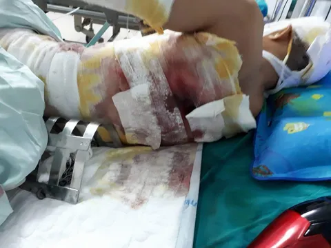 Bị bỏng nặng do điện giật trong lúc hạ cây nêu