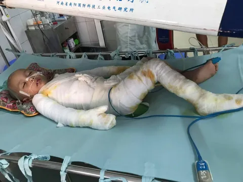 Quảng Bình: Xót thương gia đình nghèo có con bị bỏng nặng