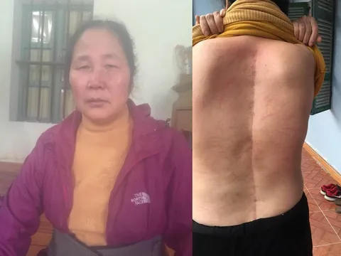 Cứu giúp người mẹ đơn thân bị ngã gãy cột sống, chăm con bị u tủy