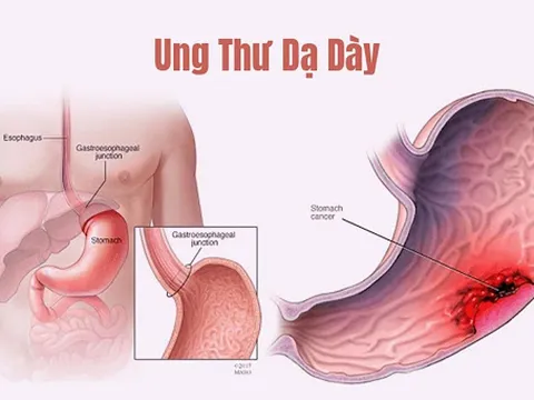 90% người đau dạ dày đang mang trong mình mầm mống ung thư dạ dày