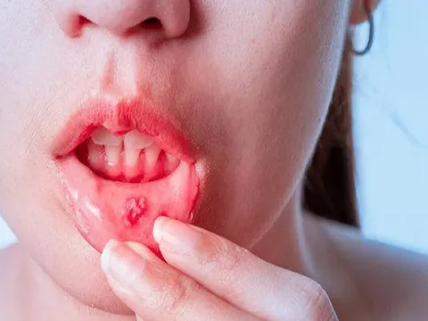 Cô gái trẻ liên tục bị nhiệt miệng, sưng lưỡi, tưởng nóng trong người ai ngờ mắc ung thư miệng dù không rượu bia, thuốc lá