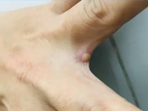 Hình ảnh vết mụn nước ở người mắc đậu mùa khỉ đầu tiên của Việt Nam