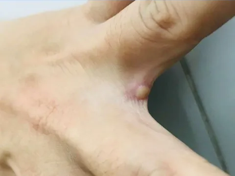 Đậu mùa khỉ có phải là bệnh lây truyền qua đường tình dục?