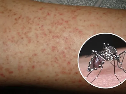 Hà Nội ghi nhận gần 10.000 ca mắc sốt xuất huyết, dự báo số ca mắc tiếp tục tăng