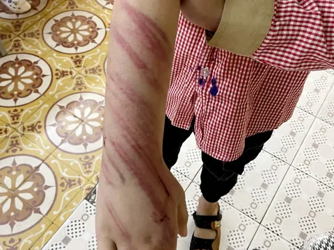 Hải Phòng: Bé trai 8 tuổi nghi bị bạn trai của mẹ bạo hành