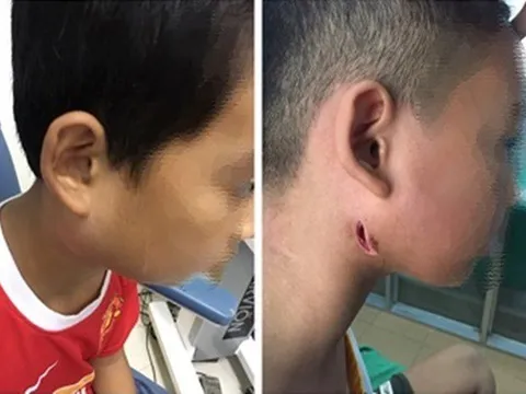 Thanh Hoá: Bệnh nhi mắc "vi khuẩn ăn thịt người" đã tử vong