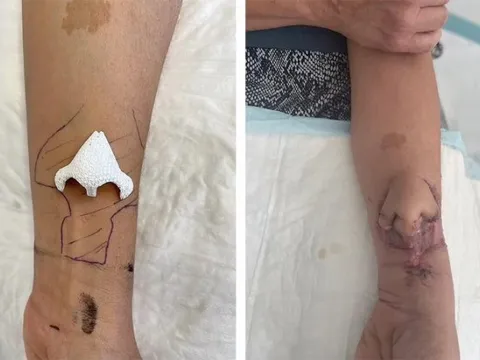 Pháp: Chiếc mũi nhân tạo được "nuôi" trên cánh tay của người phụ nữ