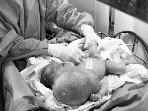 Tách thành công khối bướu bạch huyết nặng 1,1kg cho bé sơ sinh 3 ngày tuổi