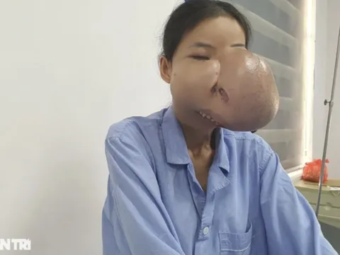 Người mẹ mang gương mặt "kỳ dị" hy sinh sự sống cho con