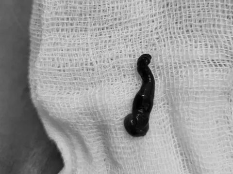 Vĩnh Phúc: Phát hiện đỉa sống trong mũi người phụ nữ nhiều tháng