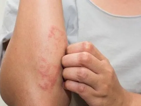 Trời lạnh, viêm da cơ địa dễ tái phát, người bệnh cần làm gì?