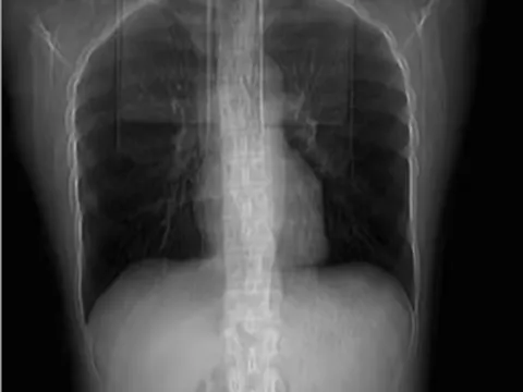 Một cô gái ho đến gãy 4 xương sườn sau bữa ăn cay