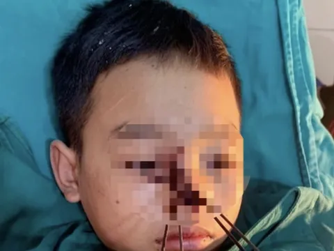 Nghệ An: Bé trai bị 4 mũi tên sắt bắn vào mặt khi dùng nỏ tự chế bắt chuột