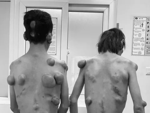 Căn bệnh khiến 2 anh em sinh đôi mọc hàng trăm khối u trên cơ thể như "người củi"
