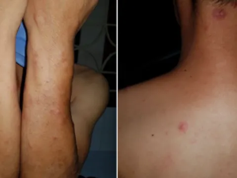 Phát hiện không ít người ở đô thị mắc bệnh phong