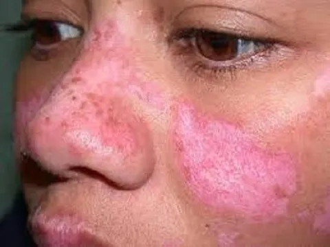 Mắc lupus ban đỏ hệ thống cần lưu ý những điều này
