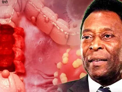 Vua bóng đá Pele mắc ung thư đại trực tràng, làm thế nào để phòng chống và ngăn ngừa bệnh này?