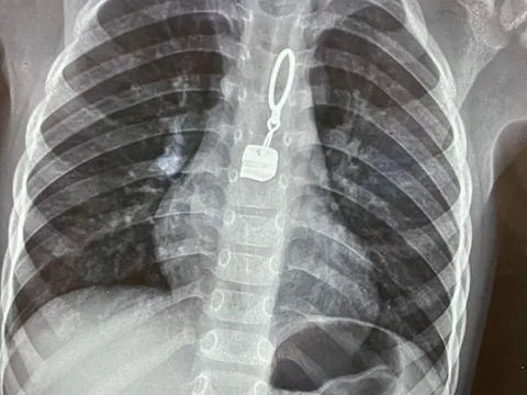 Hà Tĩnh: Phát hiện khóa kim loại trong thực quản bệnh nhi 3 tuổi