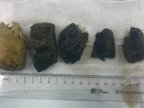 Người đàn ông nhập viện vì tắc ruột do món ăn truyền thống trong ngày Tết