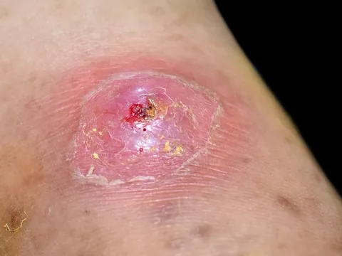 Thanh Hóa: Bệnh nhi 15 tuổi mắc bệnh Whitmore đã tử vong