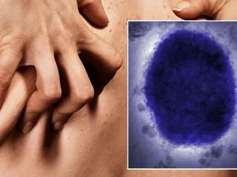 Bệnh đậu mùa khỉ bùng phát: Các triệu chứng cần lưu ý