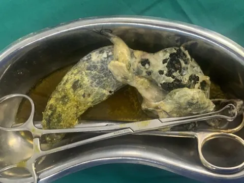 Nhiều bé gái mắc hội chứng ‘công chúa tóc mây’