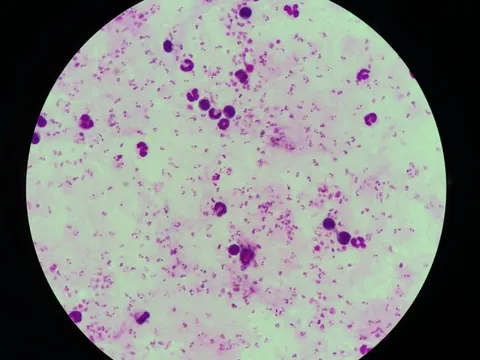 Hai người Việt từ Châu Phi về bị sốt rét ác tính