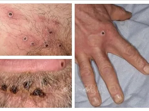 Đài Loan (Trung Quốc) ghi nhận ca bệnh đậu mùa khỉ đầu tiên 