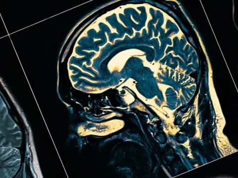 Australia tạo đột phá trong nghiên cứu về bệnh Alzheimer