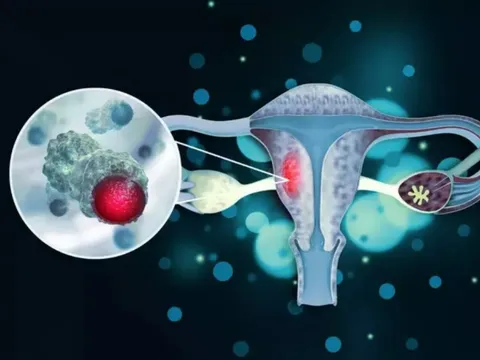 Nhiễm trùng lây qua đường tình dục: Nguyên nhân gây ung thư cổ tử cung?