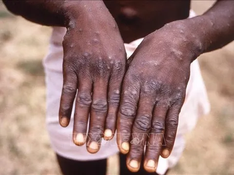 Canada nỗ lực tiếp cận các cộng đồng bị ảnh hưởng bởi bệnh đậu mùa khỉ