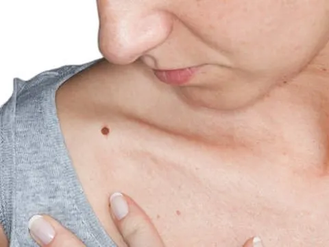 Bác sĩ Anh cảnh báo biến đổi khí hậu khiến người mắc ung thư da tăng đột biến