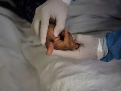 Virus đậu mùa khỉ có thể bám lâu trên các vật dụng gia đình