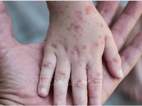 Trung Quốc: Đặc khu Hành chính Hong Kong ghi nhận ca bệnh đậu mùa khỉ đầu tiên