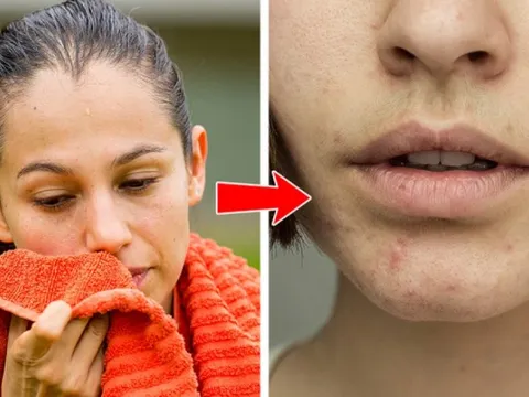 Mụn trứng cá trên cơ thể cho bạn biết gì về thói quen lối sống?