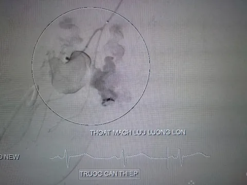 Bệnh nhân sốc đa chấn thương nguy kịch được cứu sống trong 10 phút