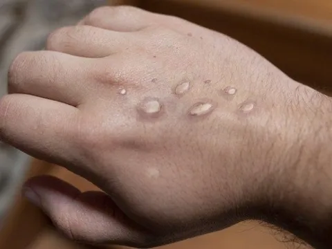 Những loại thuốc tiềm năng điều trị đậu mùa khỉ